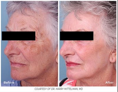 Erbium Laser Resurfacing Renew Your Skin